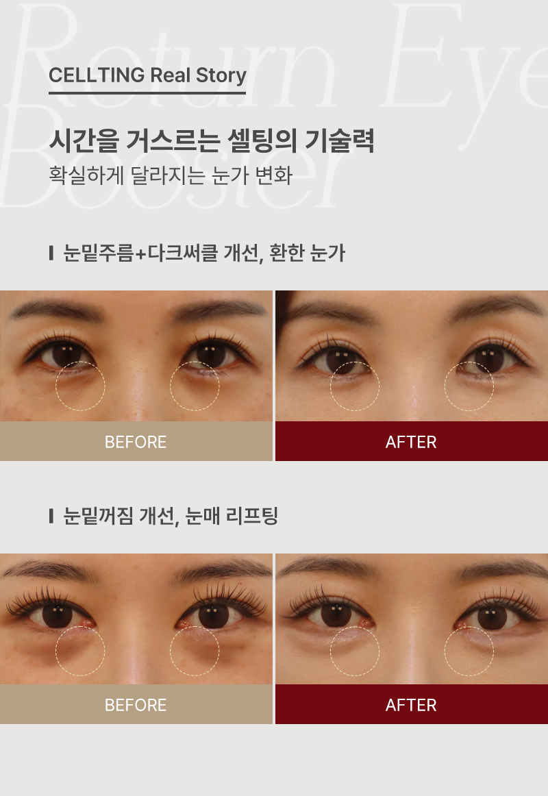 시간을 거스르는 셀팅의 기술력, 확실하게 달라지는 눈가 변화