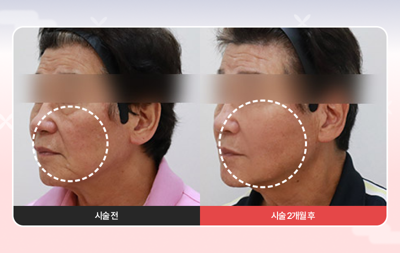 [1월 한정] 셀팅 스테디셀러! 효과보장 가성비 패키지 시술 전, 후