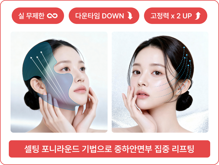 셀팅 포니라운드 기법으로 중하안면부 집중 리프팅