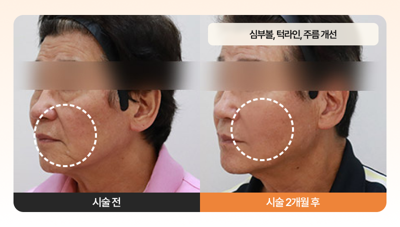 [1월 한정] 셀팅 스테디셀러! 효과보장 가성비 패키지 시술 전, 후