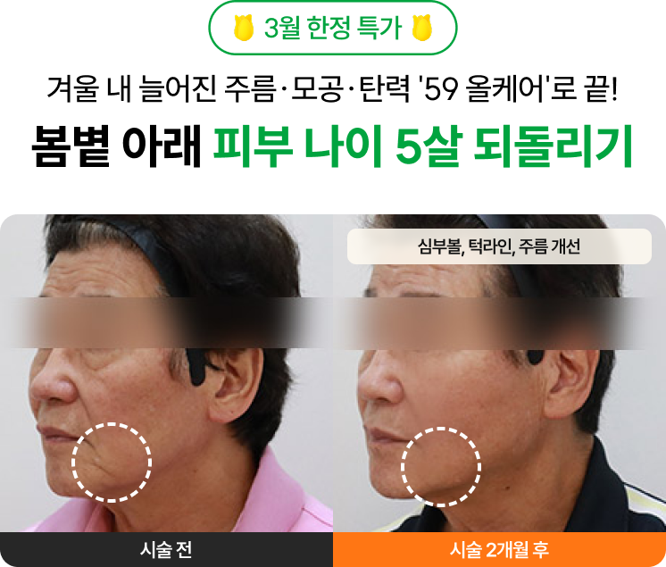 3월 한정 특가 겨울 내 늘어진 주름·모공·탄력 '59 올케어'로 끝! 봄볕 아래 피부 나이 5살 되돌리기